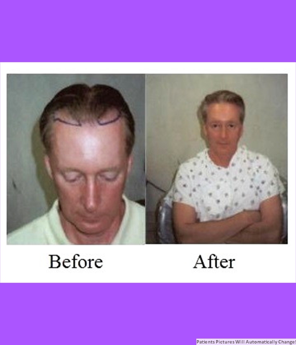  Patient Frontal Hair Transplant Cost is $1,700.00