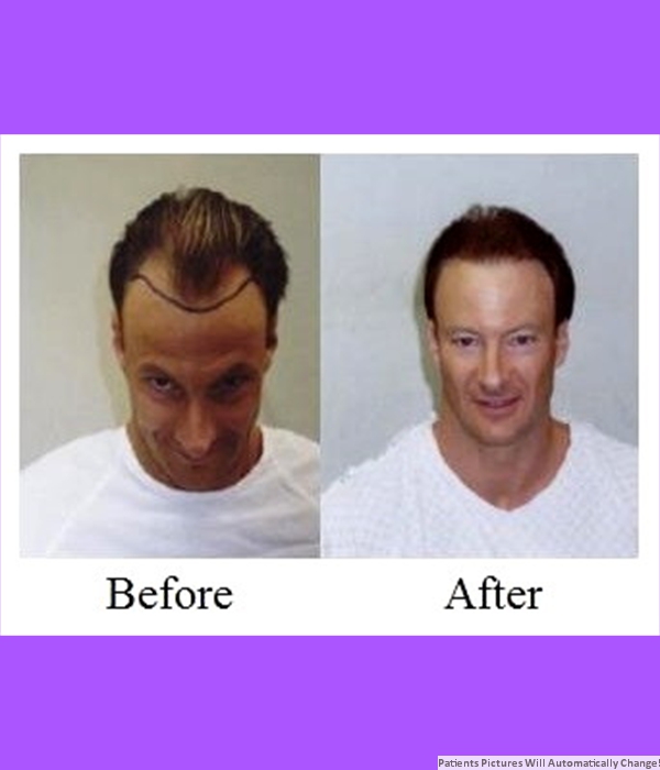 Patient Frontal Hair Transplant Cost is $1,700.00