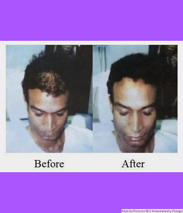 Patient Frontal Hair Transplant Cost is $1,700.00