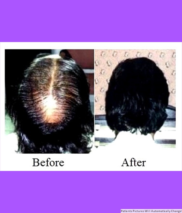  Patient Crown Hair Transplant Cost is $1,500.00