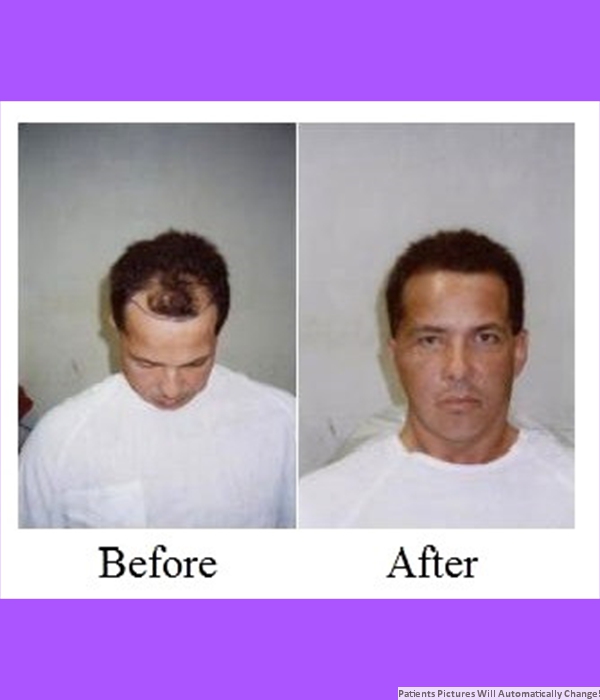 Patient Frontal Hair Transplant Cost is $2,400.00